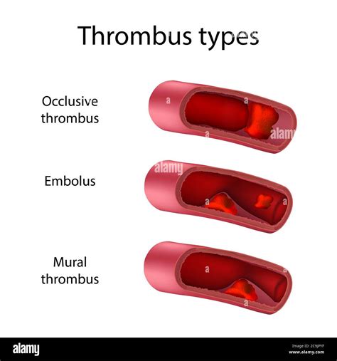 4 Forms Of Thrombus Explained