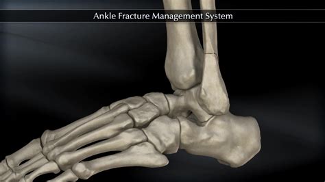 5 Essential Tips For Arthrex Ankle Fracture Inventory Control