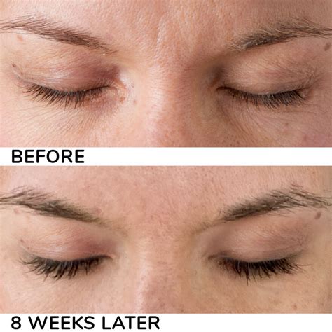 5 Generic Latisse Options For Eyelash Growth