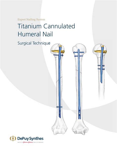 5 Tips For Effective Synthes Humeral Nail Ex Inventory Control