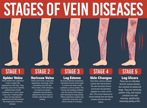 5 Ways To Identify Varicose Veins