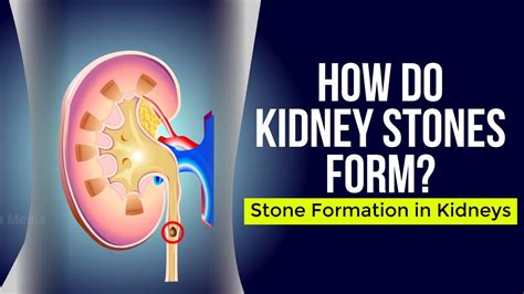 7 Ways Kidney Stones Form