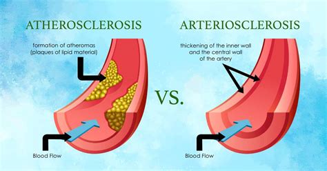 Atherosclerosis Vs Arteriosclerosis: 5 Key Differences