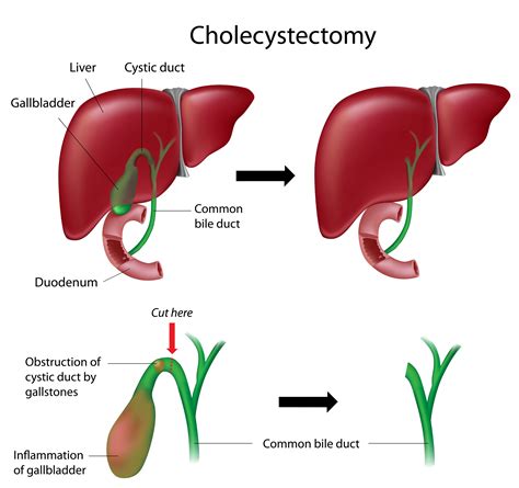 Cholecysto Meaning: Understanding The Gallbladder Combining Form