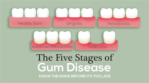 Gingivitis: Top Cause Of Periodontal Disease