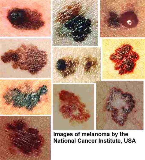 Melanoma: The Most Lethal Form Of Skin Cancer Explained