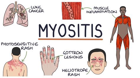 Myositis Meaning In Dermatomyositis Revealed