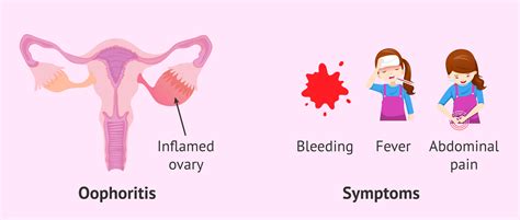 Oophor Meaning In Medical Terms