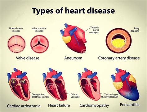 Top 5 Forms Of Cardiovascular Disease Explained