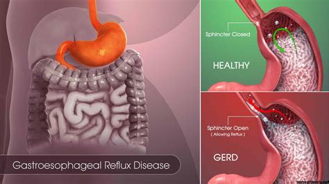 What Is Gastroesophageal Reflux Disease